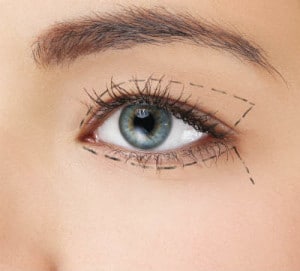 eyelid-surgery1-300x271