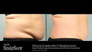 Sculpsure Before & After