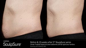 SculpSure Before and after 13 weeks following 2 SculpSure treatments