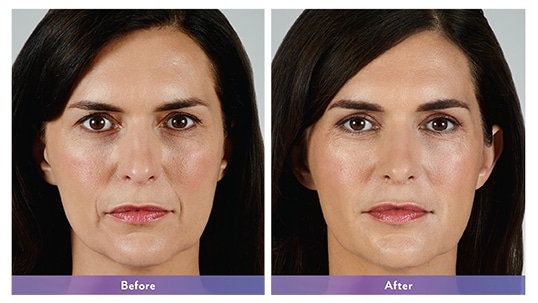 Juvederm Before/After 3