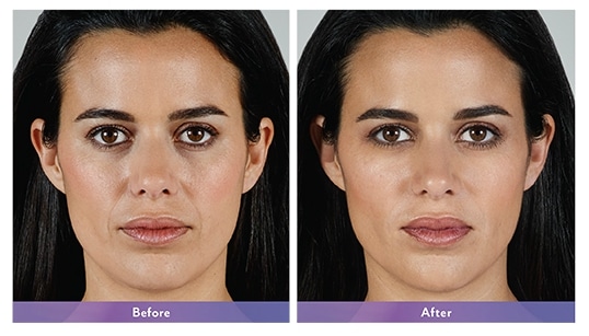 Juvederm Before/After 4