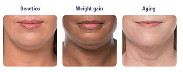 KYBELLA® Before/After 2