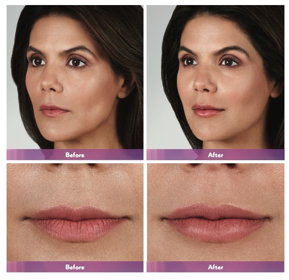 Juvederm Volbella Before/After
