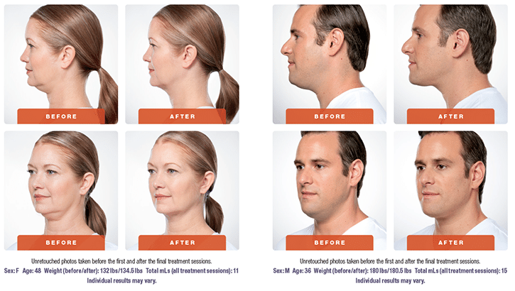 KYBELLA® Before/After 3