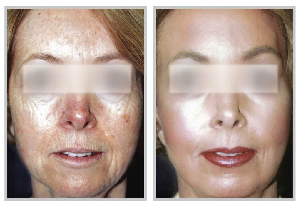 Sciton® Laser Before / After 3
