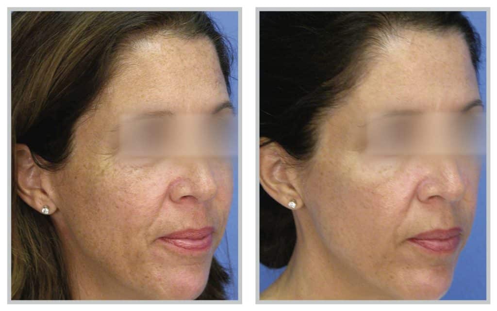 Sciton® Laser Before / After 1