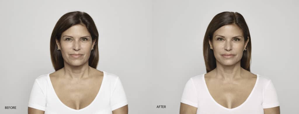 "Headshot of woman smiling in white t-shirt showing before and after results of Restylane injections against a solid grey background