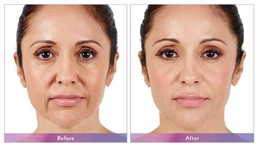 Juvederm Before/After