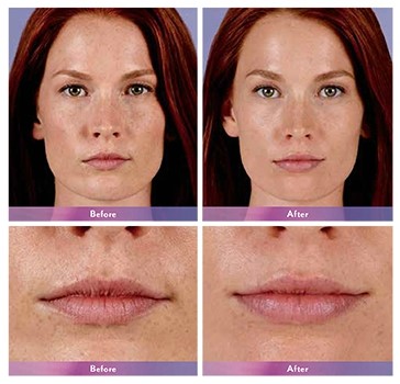 Juvederm Before/After 2