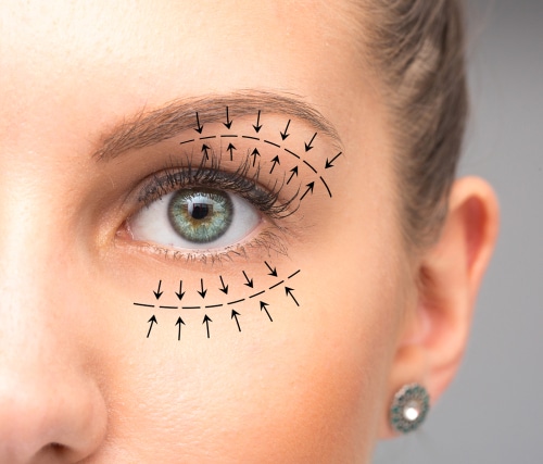 Blepharoplasty,Treatment,On,Female,Eye