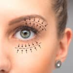 Blepharoplasty treatment on female eye