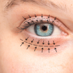 Arrows show the planned blepharoplasty surgery to lift and correct the skin and swelling.