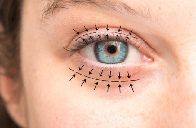 Arrows show the planned blepharoplasty surgery to lift and correct the skin and swelling.