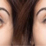 Woman eye before and after cosmetic treatment