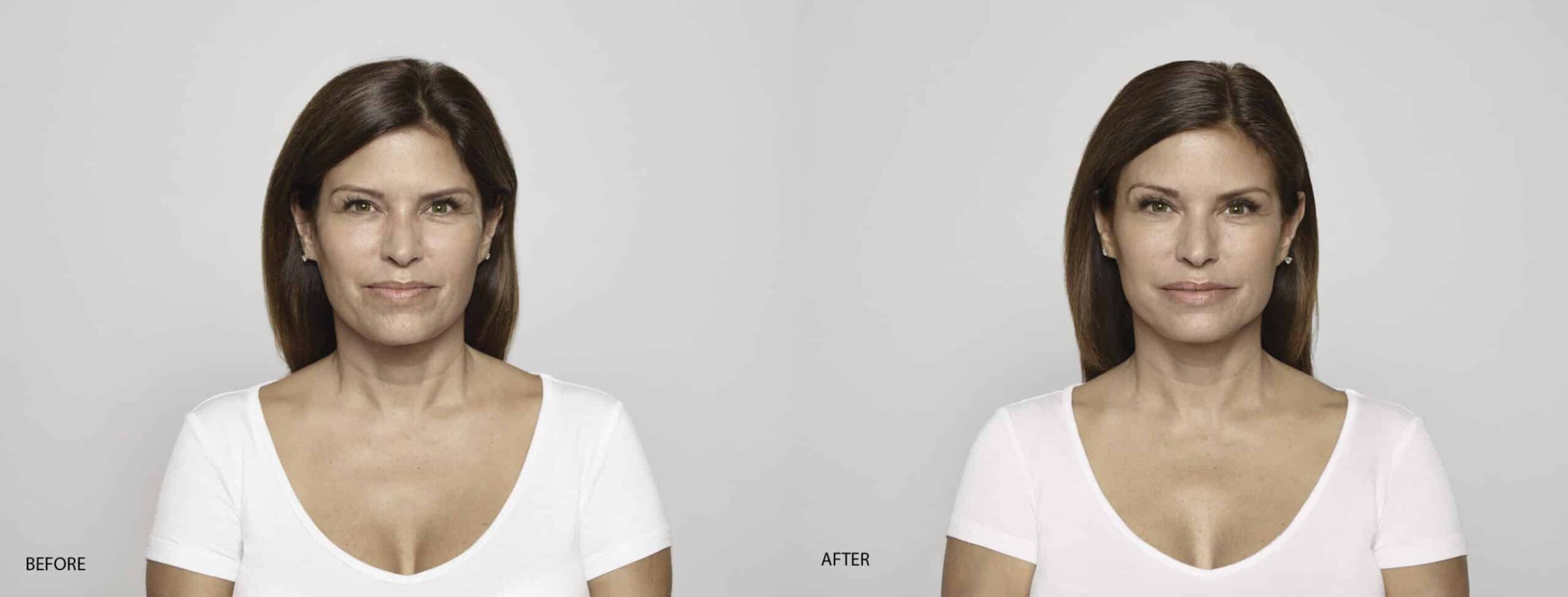 Restylane L Before AFTER