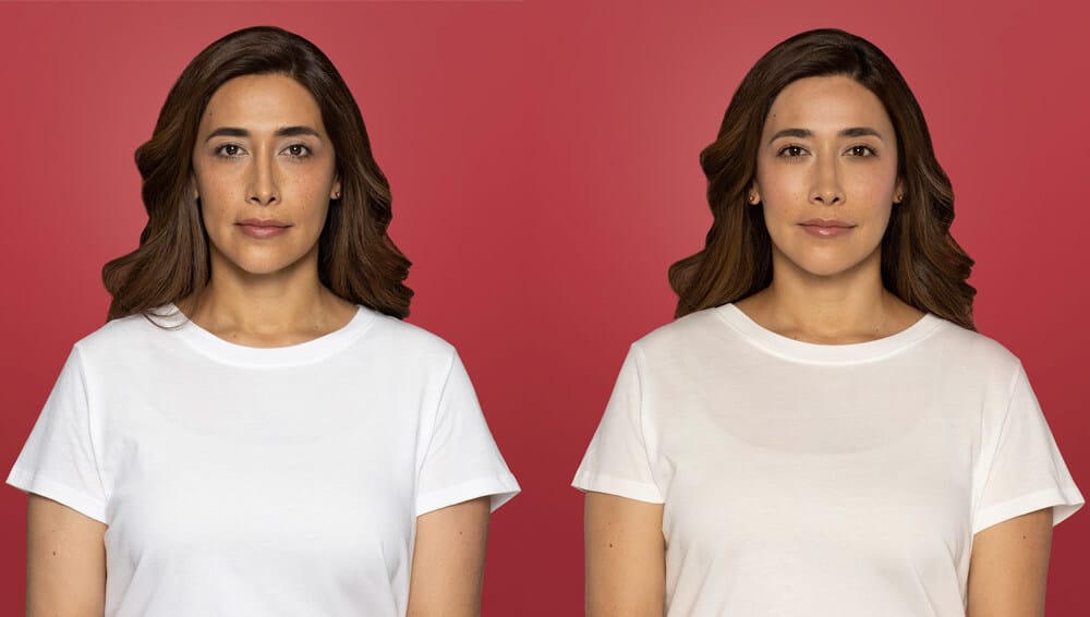 Restylane Contour before after front Restylane Contour before after front