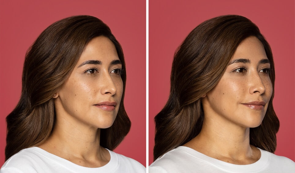 Restylane Contour before after side Restylane Contour before after side