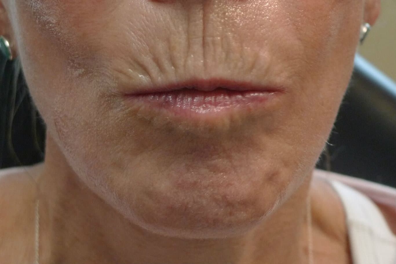 VieCBeforeLipsedited