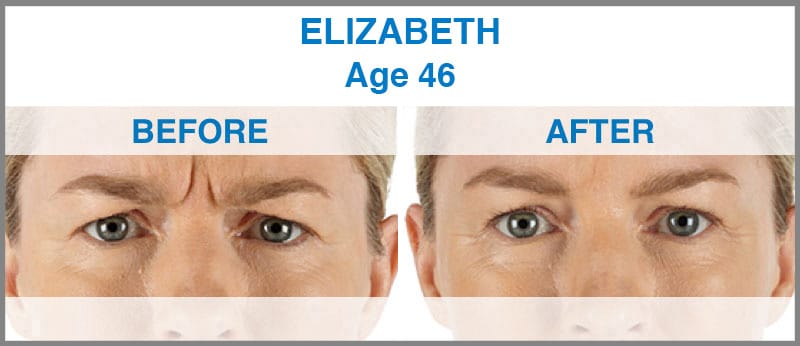 xeomin elizabeth xeomin elizabeth