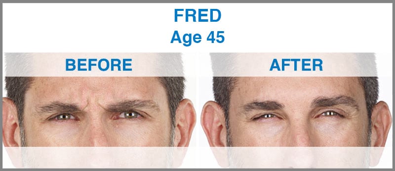 xeomin fred xeomin fred