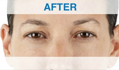 xeomin p1 after xeomin p1 after