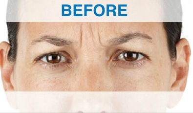 xeomin p1 before xeomin p1 before