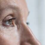 Eyelid skin cancer