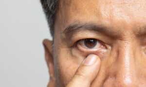Senior man experiencing eyestrain, possibly showing early signs of eyelid cancer.