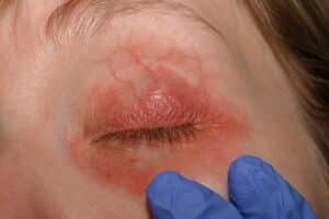 Dermatologist examining woman with red skin around eyes caused by cosmetic allergy or demodex infection