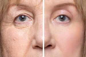 Upper and lower blepharoplasty procedure